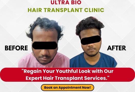 best hair transplantation in chennai