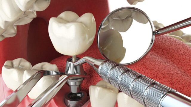prosthodontics-bangalore