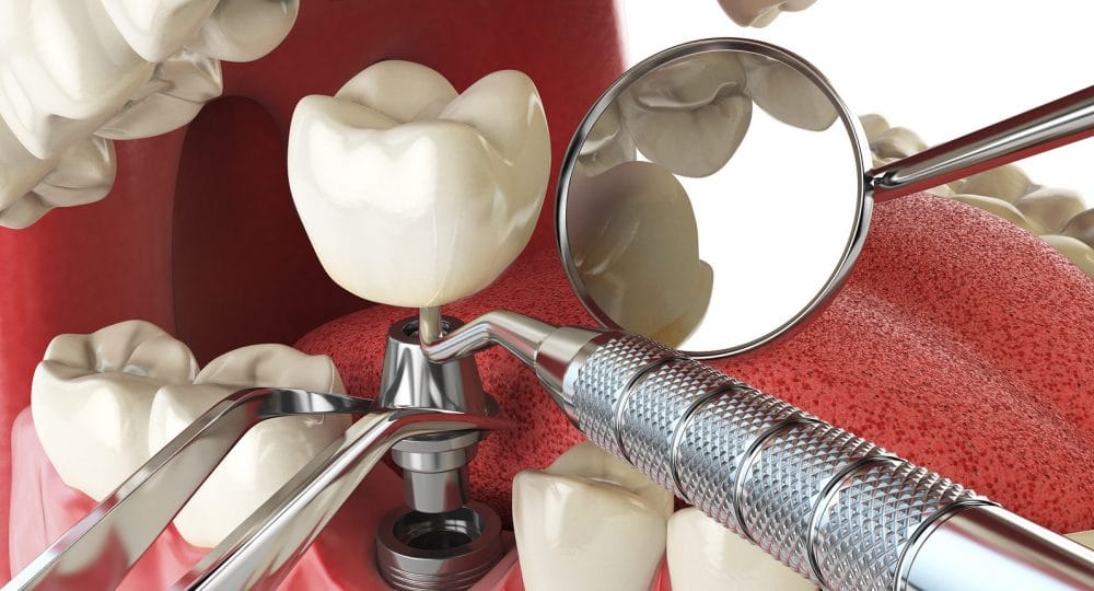 prosthodontics-bangalore