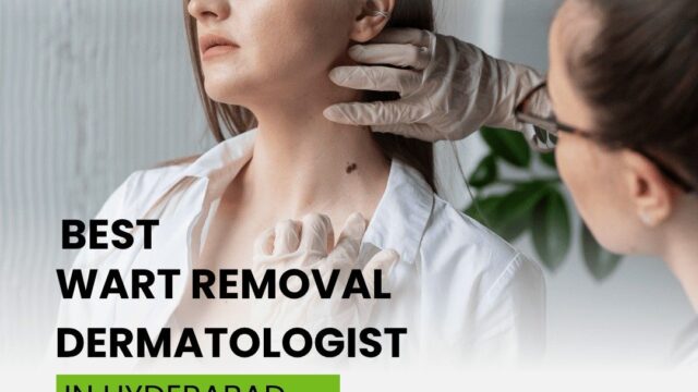 BestWartRemovalDermatologistInHyderabad